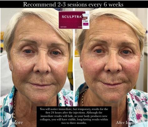sculptra results after 2 weeks|Sculptra: Before & After Results & How it Works (+ Video).